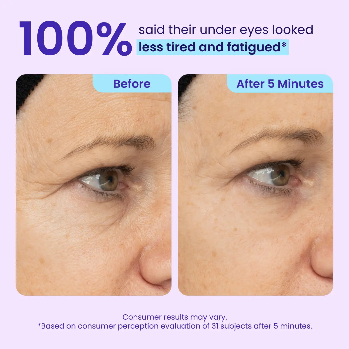 LOVILDS Erase Eye Bags in Minutes — Look Refreshed Instantly