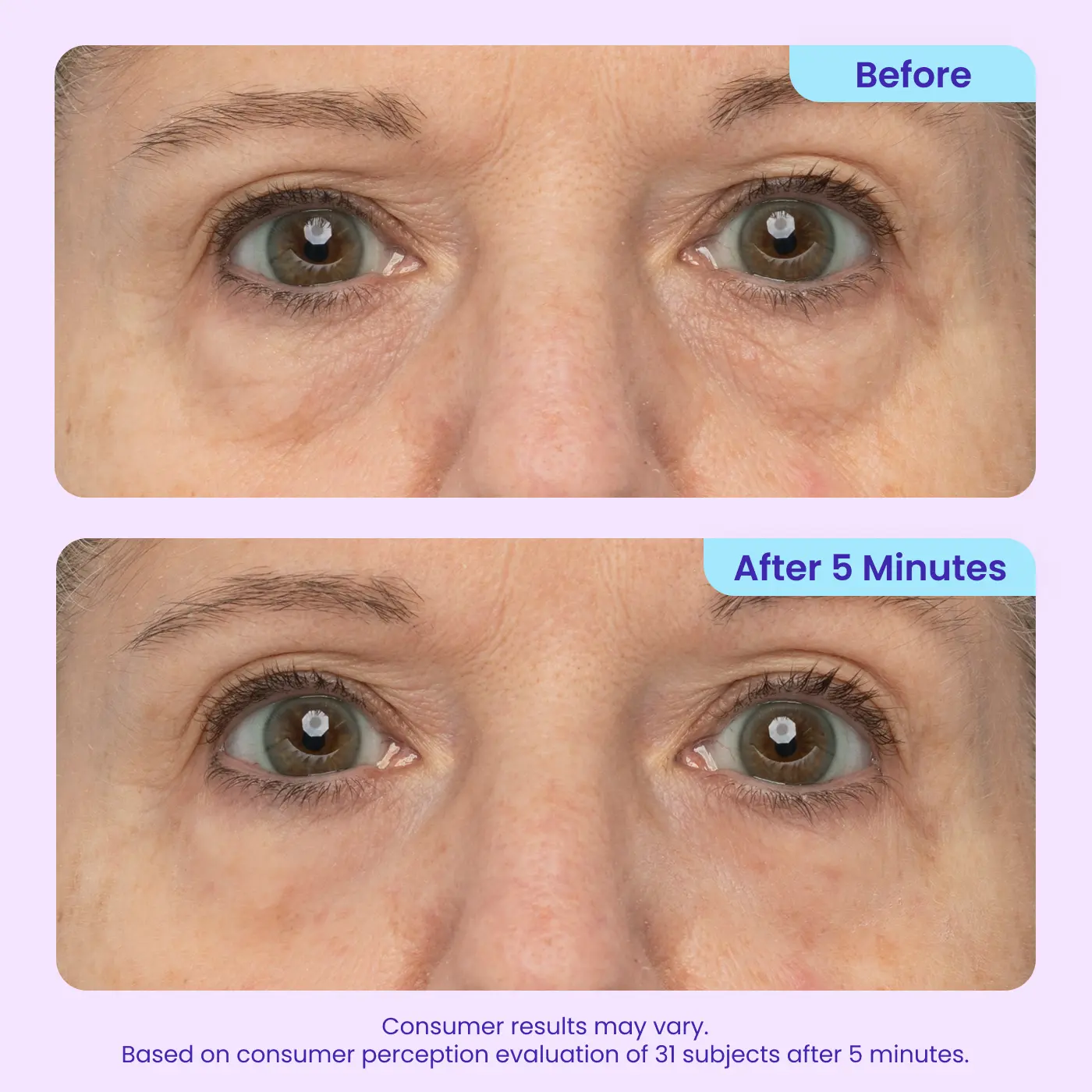 LOVILDS Erase Eye Bags in Minutes — Look Refreshed Instantly