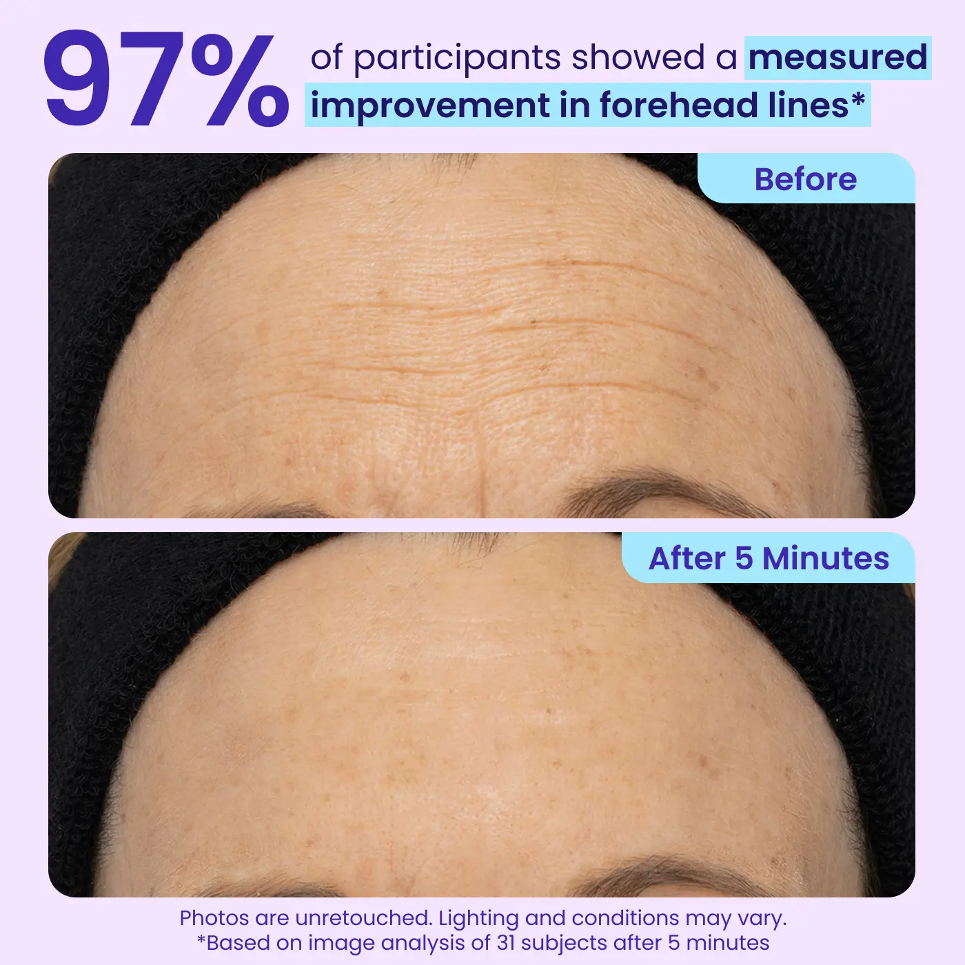 LOVILDS Erase Eye Bags in Minutes — Look Refreshed Instantly